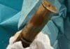 24-year-old-man-sparks-bomb-scare-after-wwi-shell-found-in-rectum