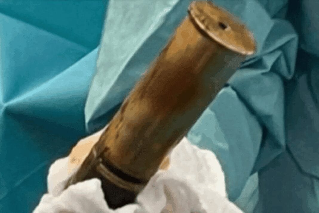 24-year-old-man-sparks-bomb-scare-after-wwi-shell-found-in-rectum