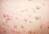In rare chickenpox case, itchy blisters mushroom into large, rubbery nodules in-rare-chickenpox-case,-itchy-blisters-mushroom-into-large,-rubbery-nodules
