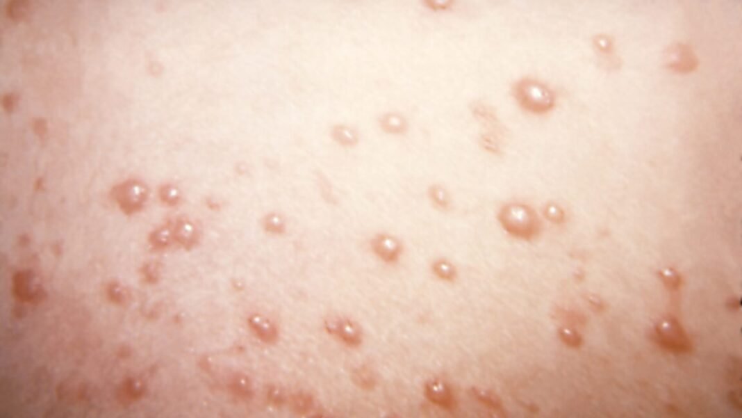 in-rare-chickenpox-case,-itchy-blisters-mushroom-into-large,-rubbery-nodules