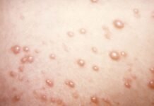 in-rare-chickenpox-case,-itchy-blisters-mushroom-into-large,-rubbery-nodules