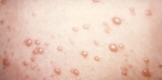 in-rare-chickenpox-case,-itchy-blisters-mushroom-into-large,-rubbery-nodules