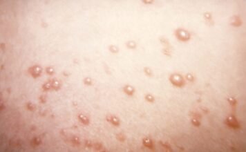 in-rare-chickenpox-case,-itchy-blisters-mushroom-into-large,-rubbery-nodules