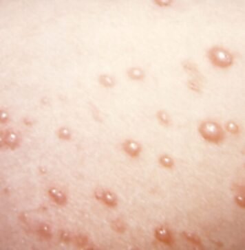 in-rare-chickenpox-case,-itchy-blisters-mushroom-into-large,-rubbery-nodules
