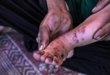 unrwa-warns-of-surge-in-disease-and-skin-infections-across-gaza