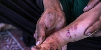 unrwa-warns-of-surge-in-disease-and-skin-infections-across-gaza