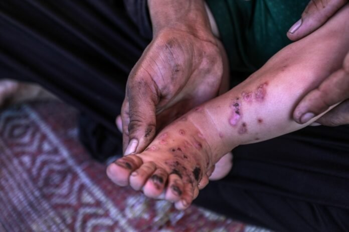 unrwa-warns-of-surge-in-disease-and-skin-infections-across-gaza unrwa-warns-of-surge-in-disease-and-skin-infections-across-gaza