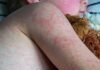 analysis-of-texas-measles-outbreak-shows-just-how-dangerous-virus-is