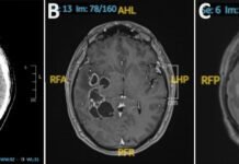 doctors-suspected-man-had-brain-cancer-he-actually-had-worms.