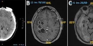 doctors-suspected-man-had-brain-cancer-he-actually-had-worms.