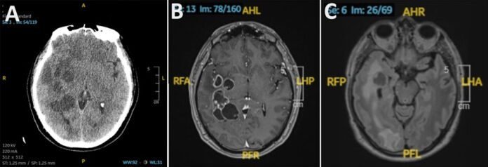 doctors-suspected-man-had-brain-cancer-he-actually-had-worms.