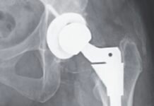 woman’s-hip-replacement-disintegrates,-causing-severe-metal-poisoning