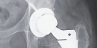 woman’s-hip-replacement-disintegrates,-causing-severe-metal-poisoning