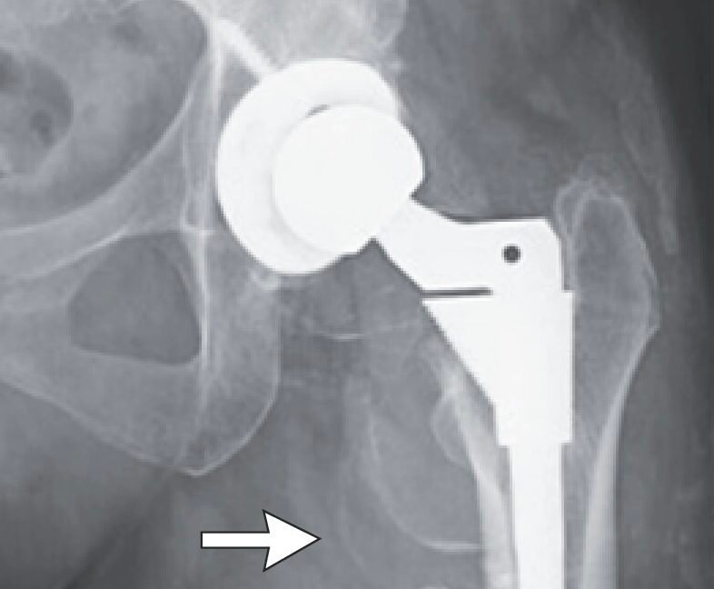 woman’s-hip-replacement-disintegrates,-causing-severe-metal-poisoning woman’s-hip-replacement-disintegrates,-causing-severe-metal-poisoning