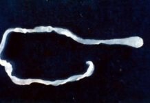 surprised-doctors-find-10-inch-worm-in-man’s-groin-during-elective-surgery