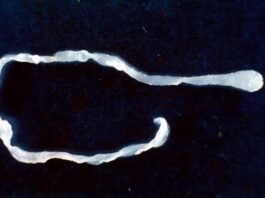 surprised-doctors-find-10-inch-worm-in-man’s-groin-during-elective-surgery