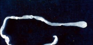 surprised-doctors-find-10-inch-worm-in-man’s-groin-during-elective-surgery