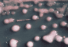 A woman got a UTI. Two years later, the bacteria had evolved, invaded her brain. a-woman-got-a-uti-two-years-later,-the-bacteria-had-evolved,-invaded-her-brain.
