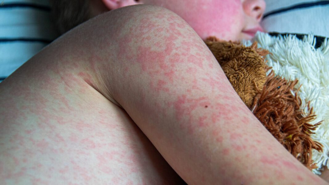 two-unvaccinated-people-die-from-measles-in-pennsylvania,-officials-confirm