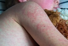 two-unvaccinated-people-die-from-measles-in-pennsylvania,-officials-confirm