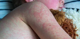two-unvaccinated-people-die-from-measles-in-pennsylvania,-officials-confirm