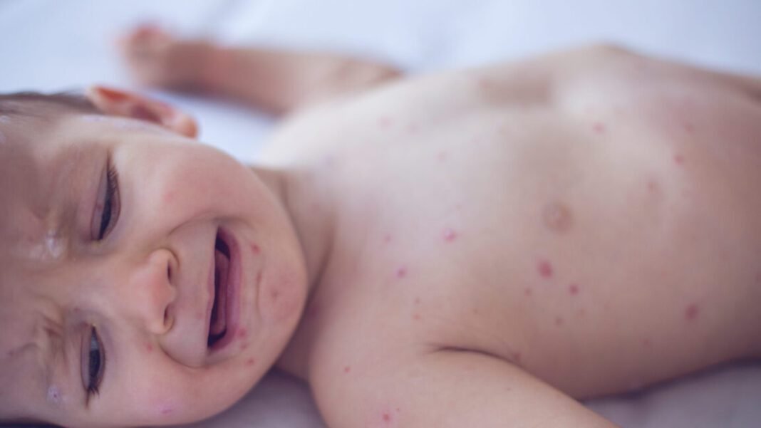measles-killed-6-week-old-baby,-coroner-confirms-after-rfk-jr.-disputed-deaths measles-killed-6-week-old-baby,-coroner-confirms-after-rfk-jr.-disputed-deaths