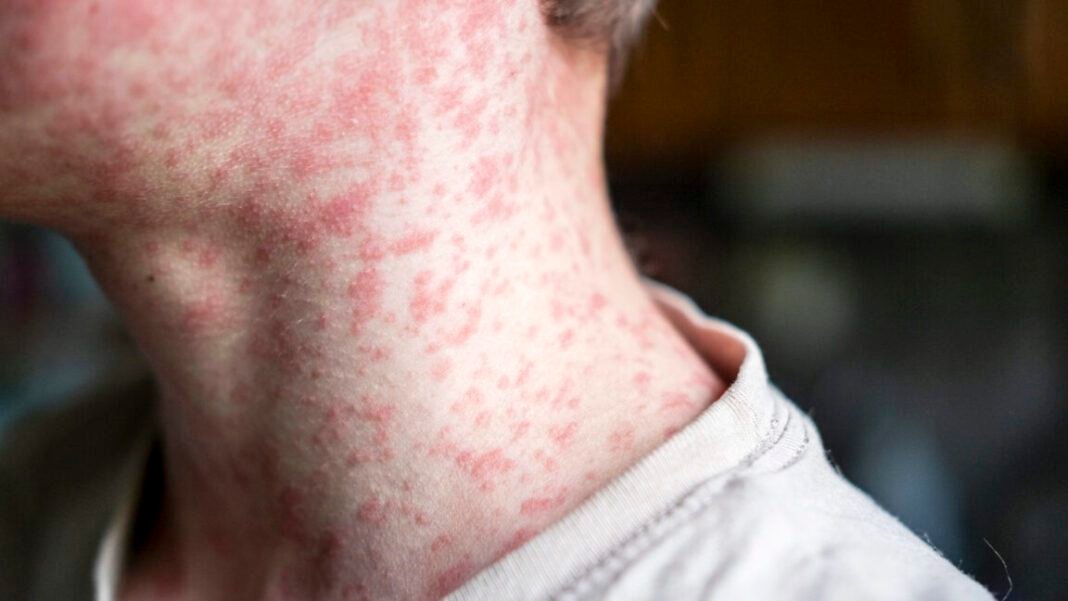 18-year-old-dies-of-measles-in-pa-from-severe-neurological-complication