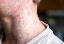 18-year-old-dies-of-measles-in-pa-from-severe-neurological-complication