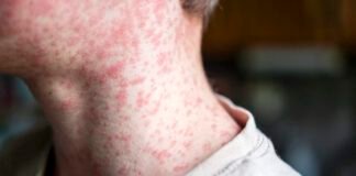 18-year-old-dies-of-measles-in-pa-from-severe-neurological-complication