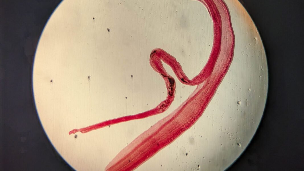 woman’s-brain-worm-infection-confirmed-after-eggs-grow-tails-in-lab-test woman’s-brain-worm-infection-confirmed-after-eggs-grow-tails-in-lab-test
