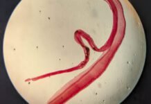 Woman’s brain worm infection confirmed after eggs grow tails in lab test woman’s-brain-worm-infection-confirmed-after-eggs-grow-tails-in-lab-test
