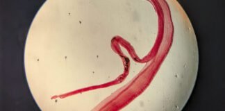 woman’s-brain-worm-infection-confirmed-after-eggs-grow-tails-in-lab-test