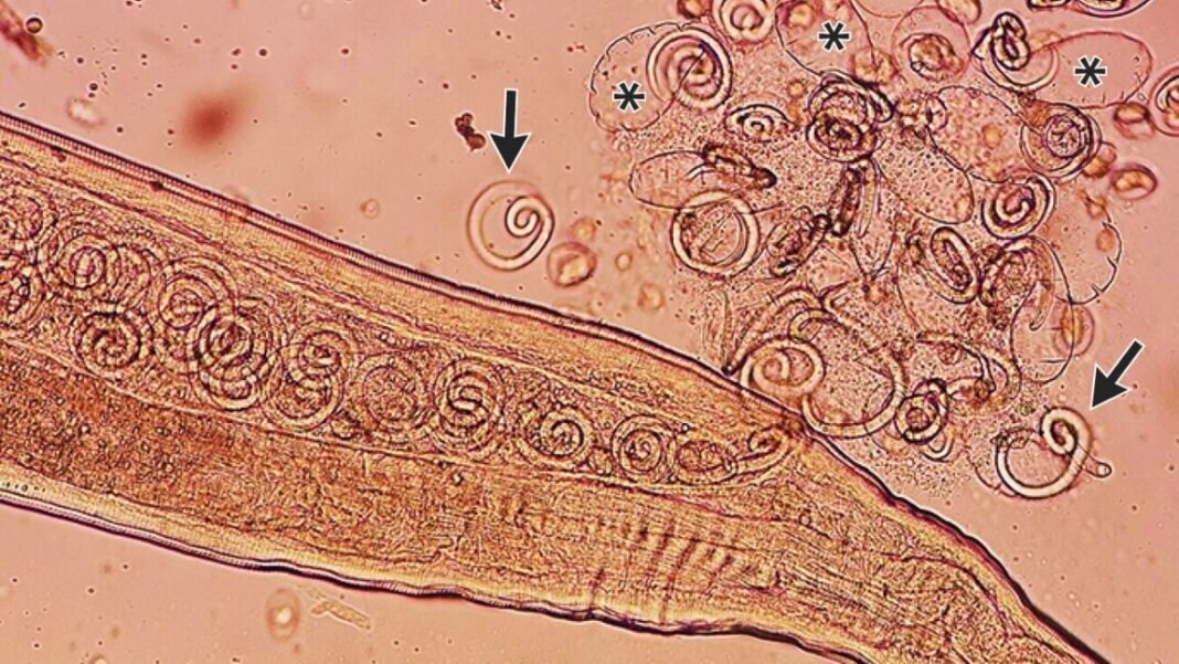 worms-mate-in-man’s-eyes,-get-plucked-out-right-before-larvae-burst-out worms-mate-in-man’s-eyes,-get-plucked-out-right-before-larvae-burst-out
