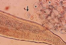Worms mate in man’s eyes, get plucked out right before larvae burst out worms-mate-in-man’s-eyes,-get-plucked-out-right-before-larvae-burst-out