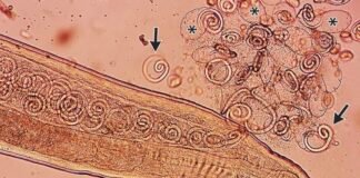 worms-mate-in-man’s-eyes,-get-plucked-out-right-before-larvae-burst-out
